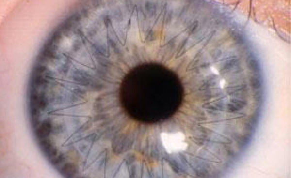 Closeup of an eye that has had a corneal transplant