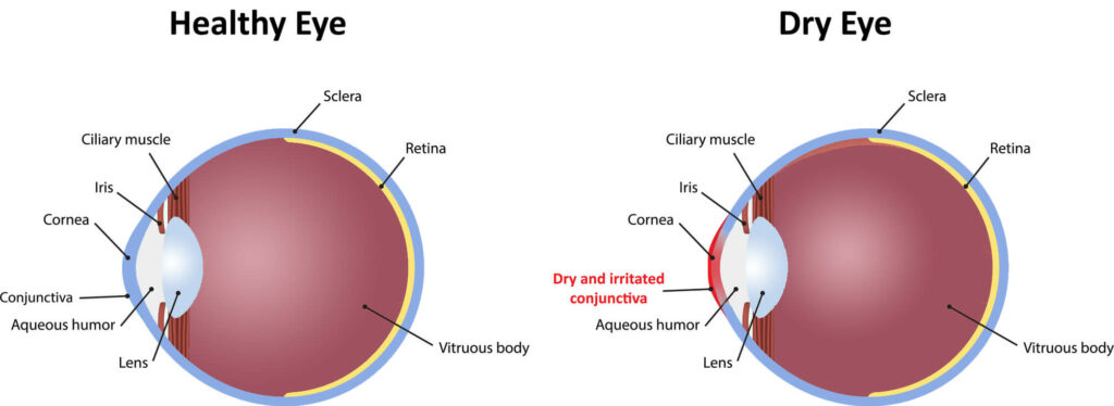 Chart Illustrating a Healthy Eye vs One Experiencing Dry Eye