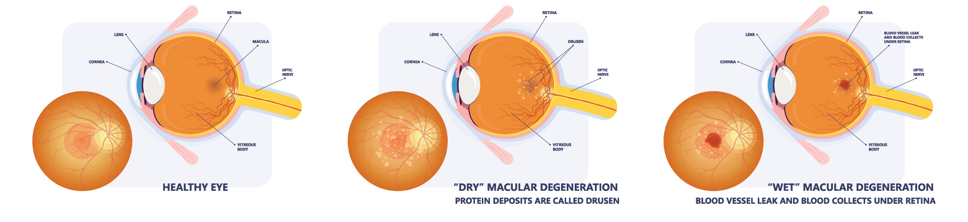 Chart Illustrating How Macular Degeneration Affects an Eye